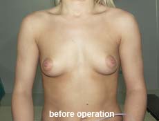 plastic-surgery-breast-augmentation 